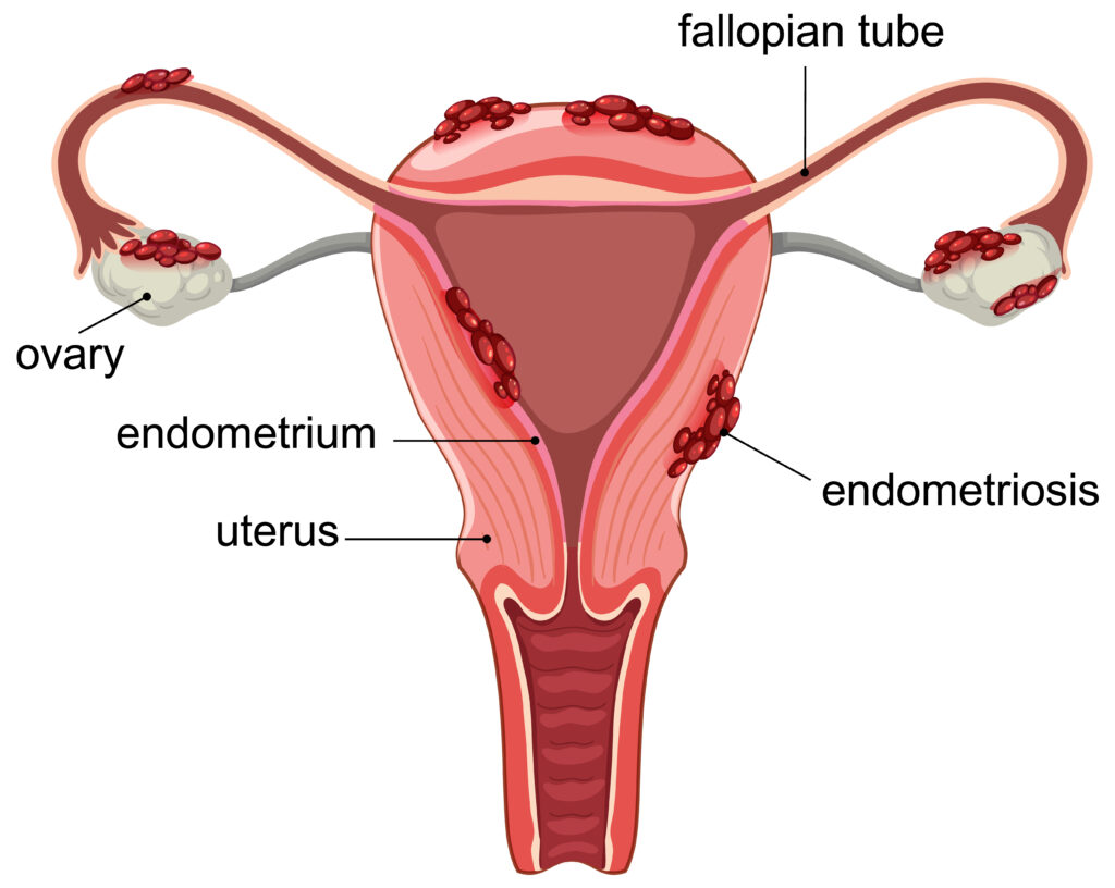 Understanding Endometriosis